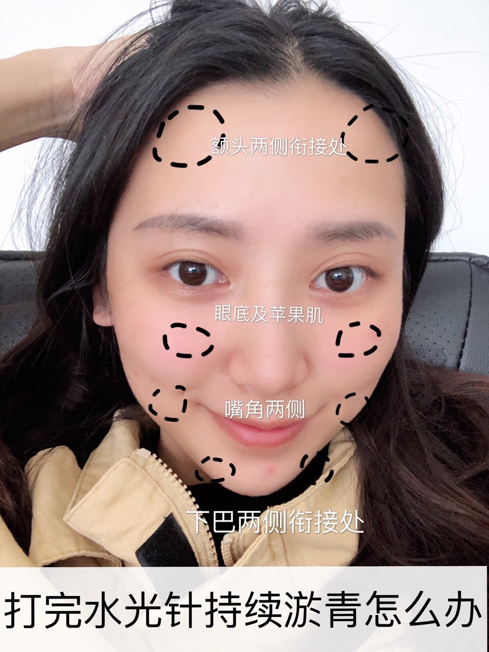 水光针如何避免针眼淤青以及术后常见问题
