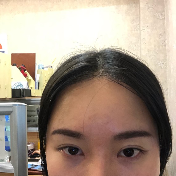 9494圆钝内眼角变尖的秘密9215内眼角修复_-.