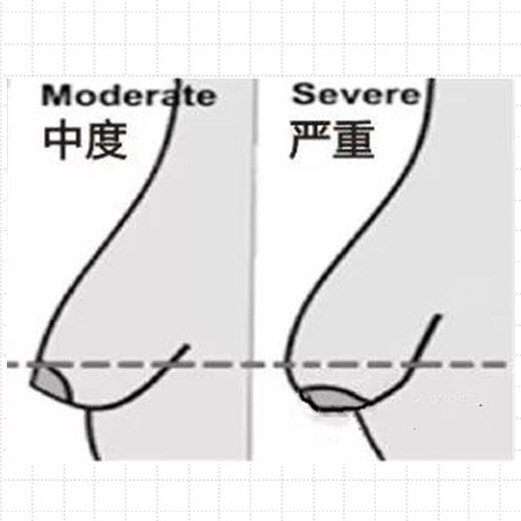 乳房下垂矫正