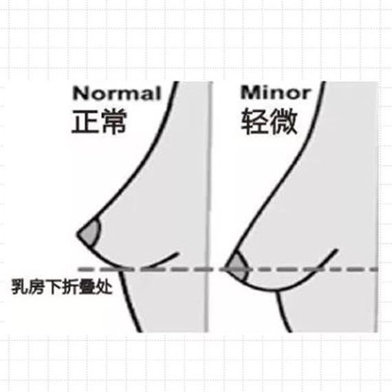 【91原来91你的乳房93只是假性7215下垂!】