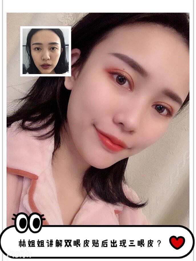 为什么使用双眼皮贴后出现了三眼皮?