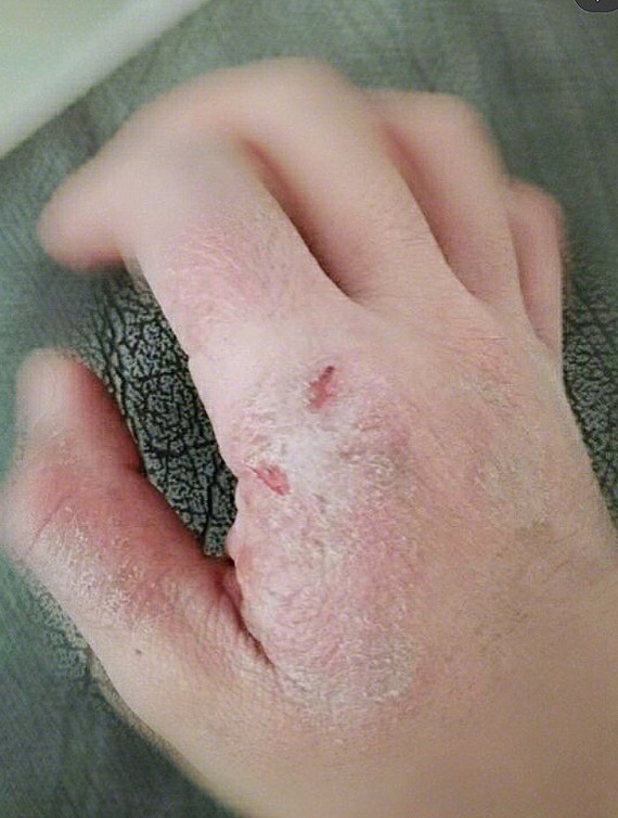 手癣是发生于掌面的真菌病,俗称"鹅掌疯".