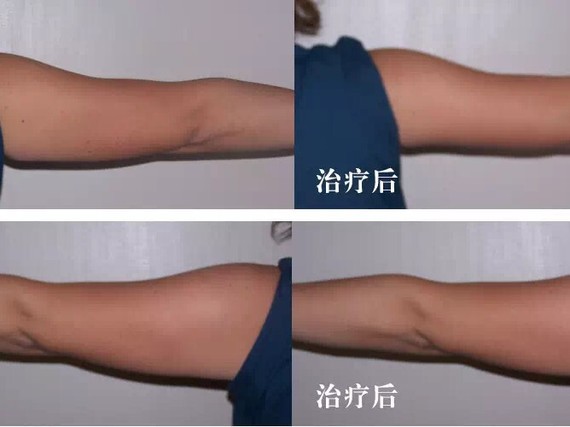辣椒的同时,让皮肤不松垂?吸脂减肥是v辣椒吸脂膏图片