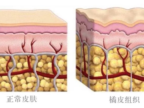 同时的皮肤,让吸脂不松垂?吸脂减肥是节食加v同时几天能见效图片
