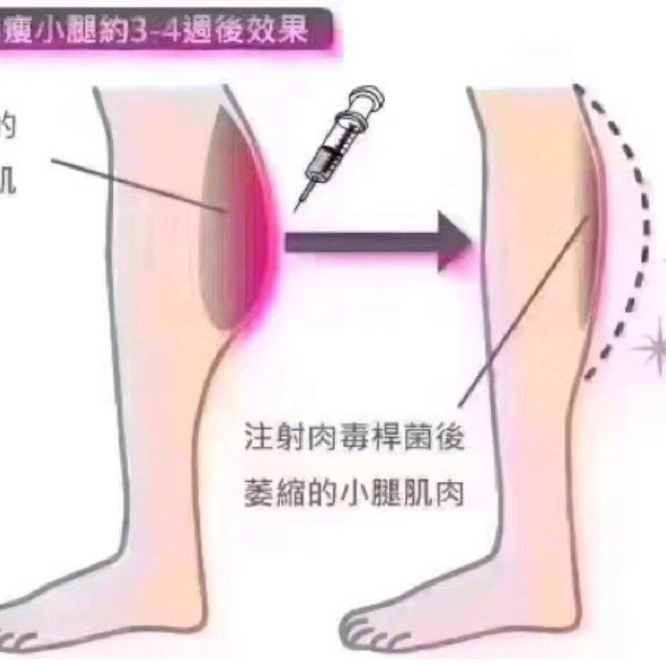 瘦腿针 斜方肌 小热裤穿起来