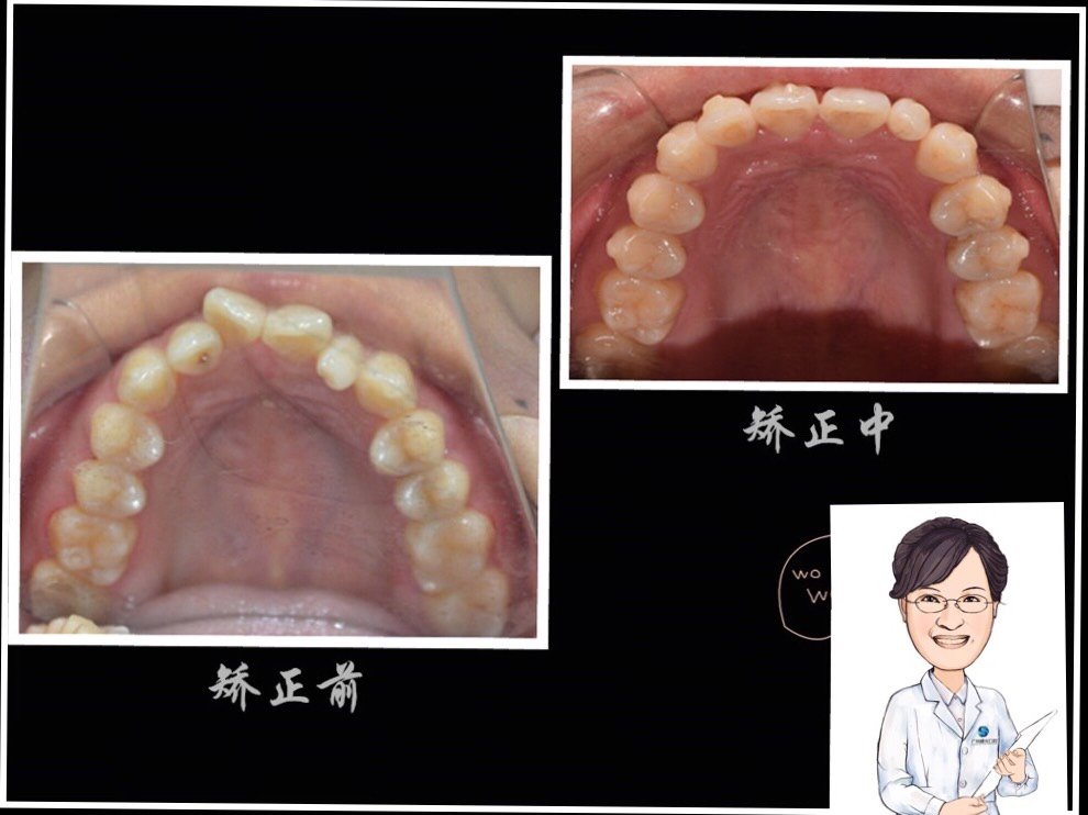 牙弓不对称?弧度笑线不美观?美学矫正通通_圈子-新氧美容整形