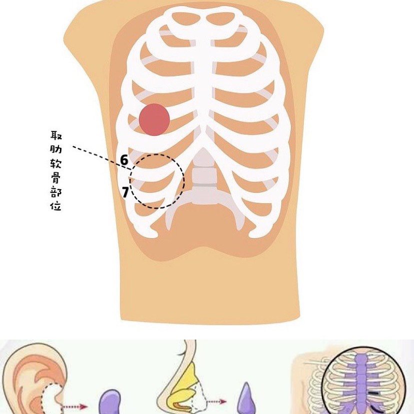 7215肋软骨隆鼻真的是"买一送一"96做完鼻子法令纹都_圈子-新氧