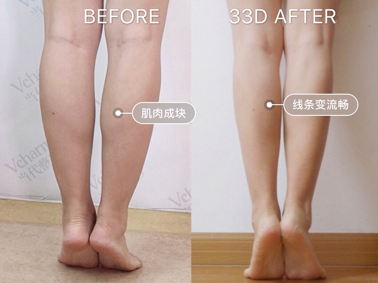 什么人适合打瘦腿针?】#_圈子-新氧