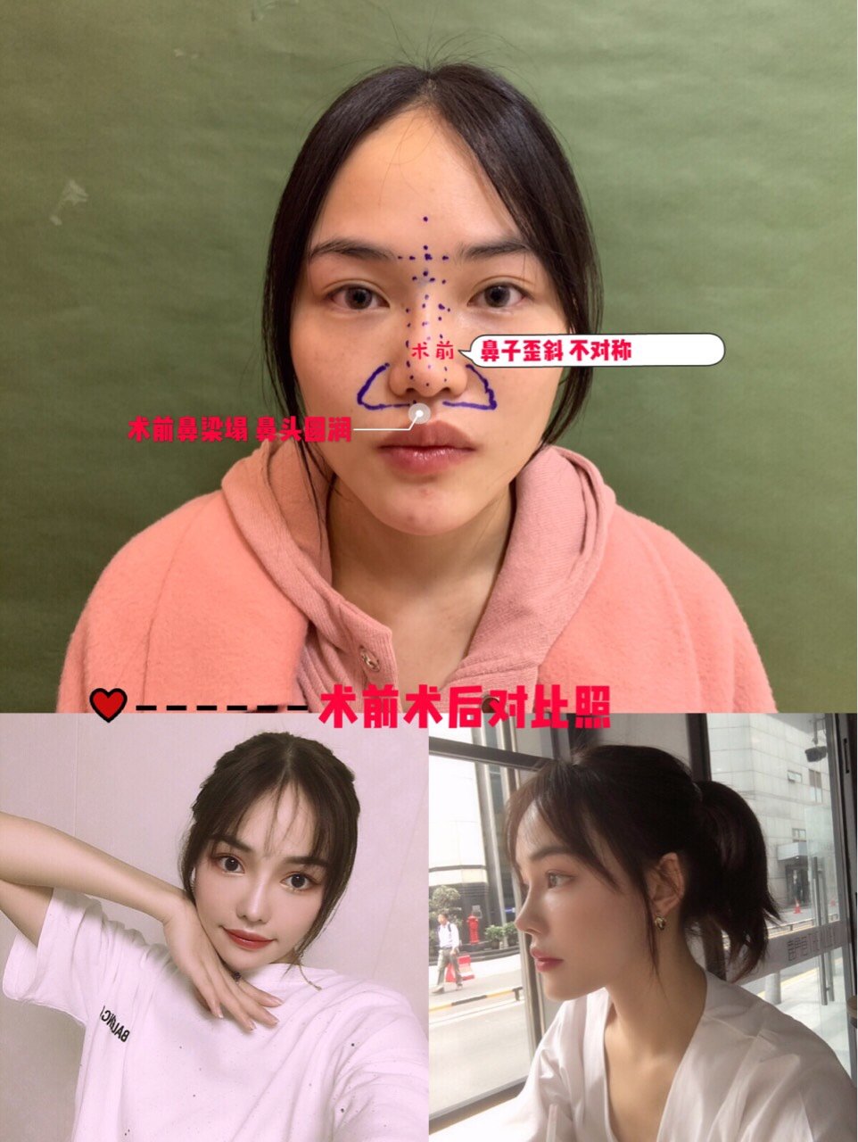 鼻子歪斜如何修复