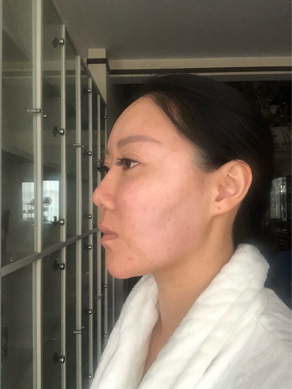 提问帖#请问我做了鼻子2年多,是假体耳软骨,为何鼻尖没起来,是不是