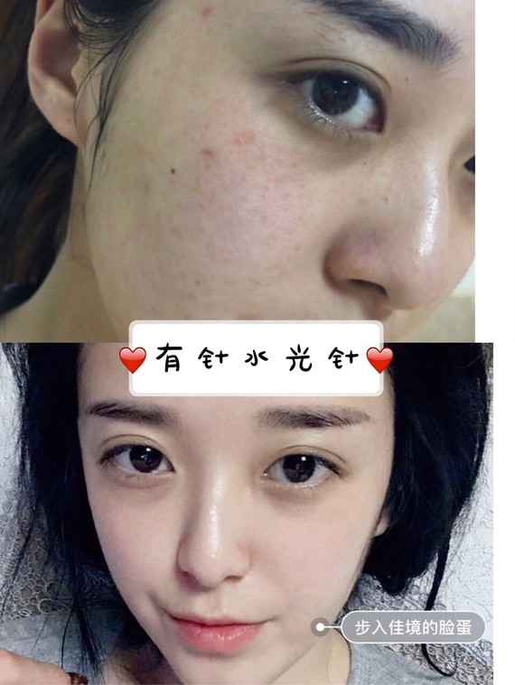 无针水光补水