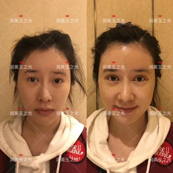 自体脂肪填充额头
