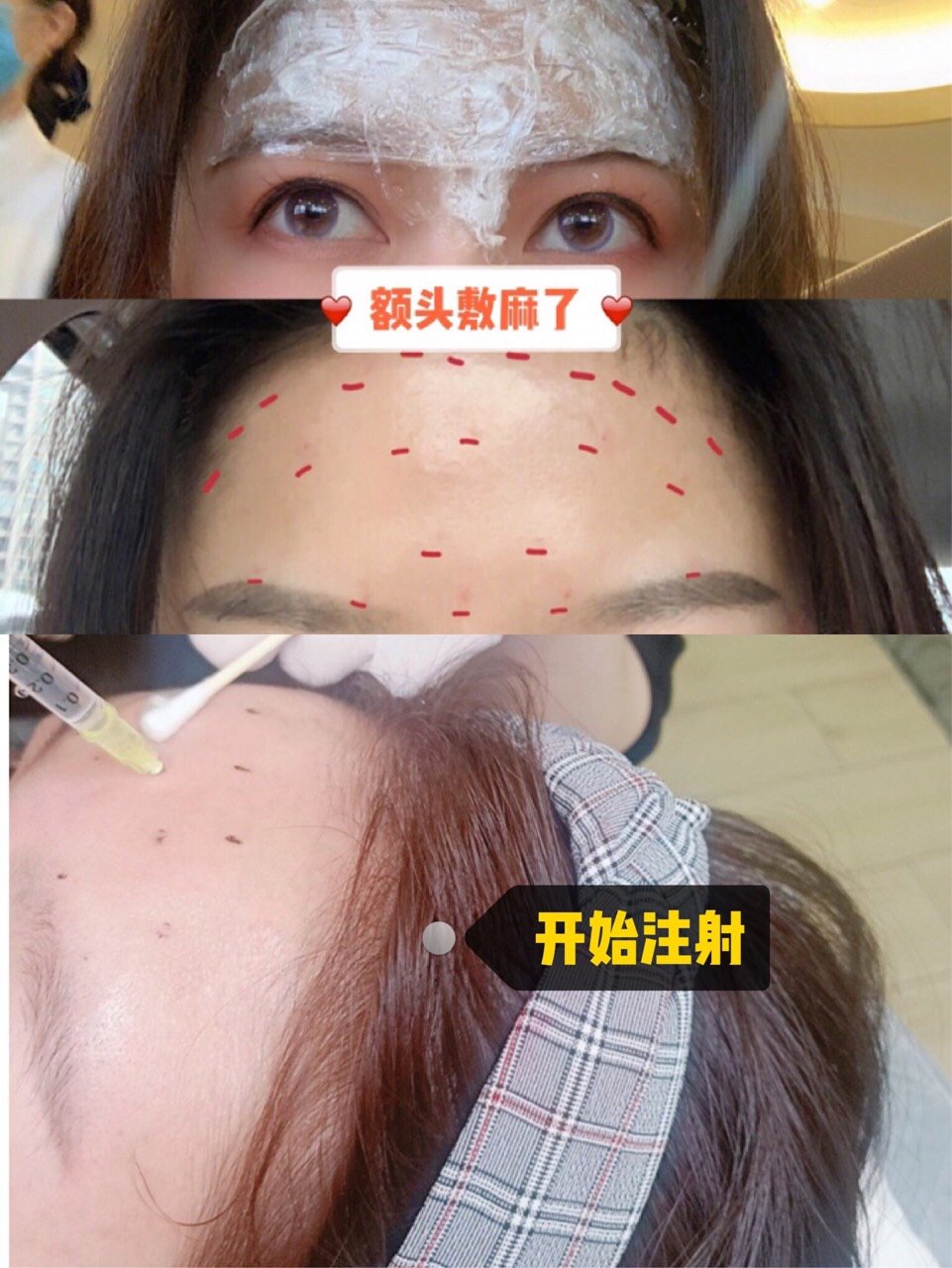 抬头纹/鱼尾纹—除皱针大法好