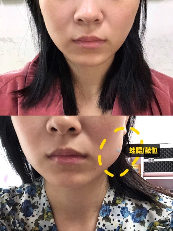 打瘦脸针有哪些危害?95说到瘦脸,相信每个女孩子都