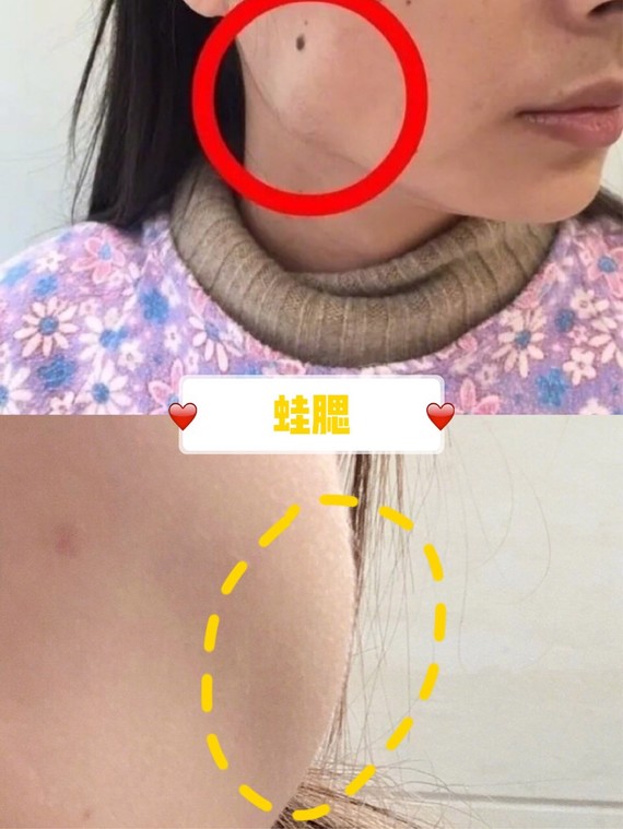 打瘦脸针有哪些危害?