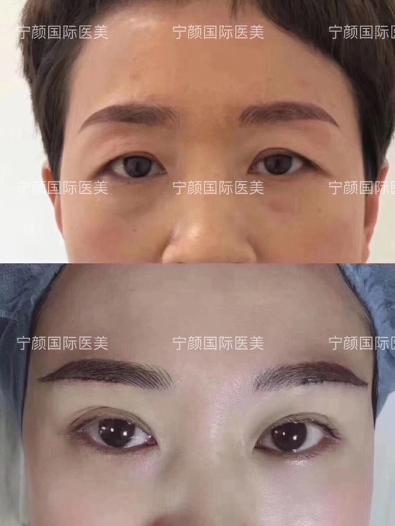 眉目传情99下垂的眼皮没精神又显老91提眉与切眉