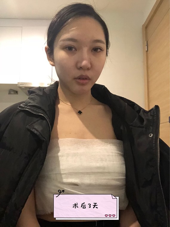 平胸隆胸220cc效果图,曼托圆盘250隆胸前后图 平胸变大胸?99隆胸手术第二弹#重庆探店#02半