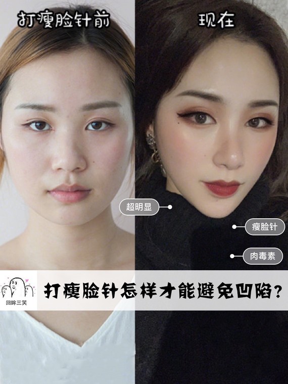 但有的网友说,打完瘦脸针脸部会凹陷,显得颧骨更突出!