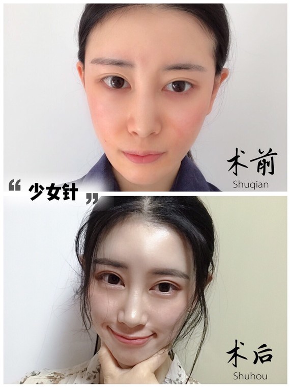不建议注射地在内女生针?!之前有看到网大是多码l少女图片