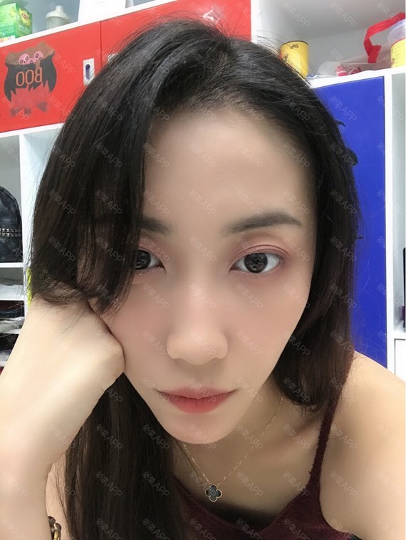科开始发源青春线,手术当天从今天种植我就不高清女生动漫图片发际图片