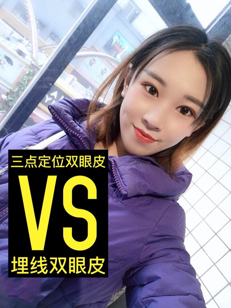 三点定位双眼皮vs埋线双眼皮