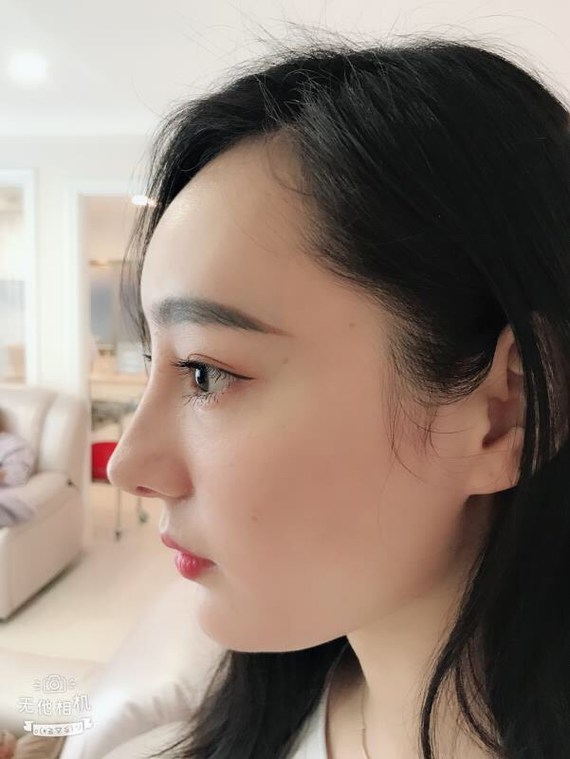 手术方式:膨体 耳软骨垫鼻尖 鼻尖塑形 歪鼻矫正 鼻翼改薄 手术恢复