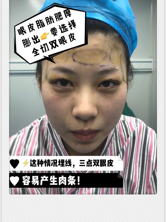 如何分辨双眼皮肉条是"真性"还是"假性"?
