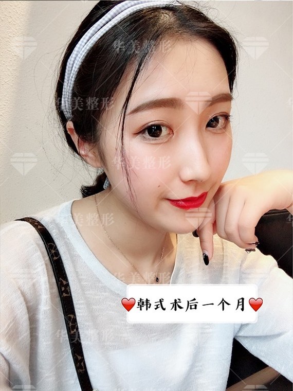 科普帖 | 韩式三点双眼皮真的是无创吗?