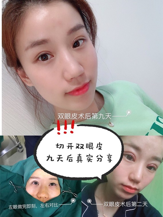 切开双眼皮亲测!九天后我的的真实感受