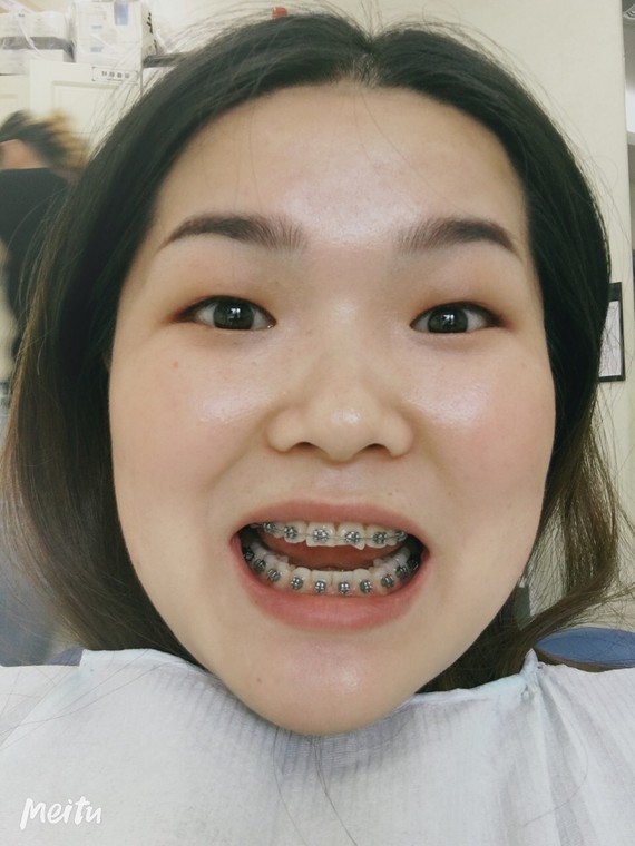 自锁牙套复诊记#7915每月复诊00,上个月拔了两颗四_圈子-新氧