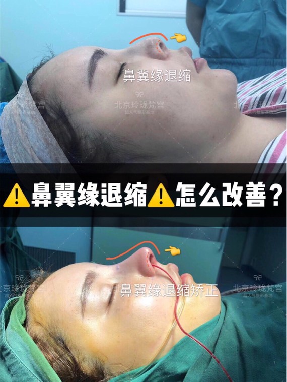 摆脱露鼻孔,鼻翼缘退缩如何改善?