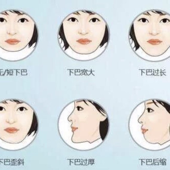 下巴截骨前移