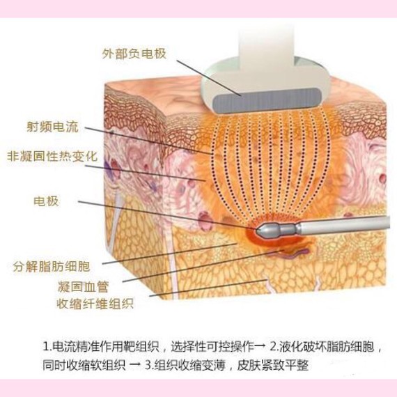 和传统吸脂,光纤溶脂在