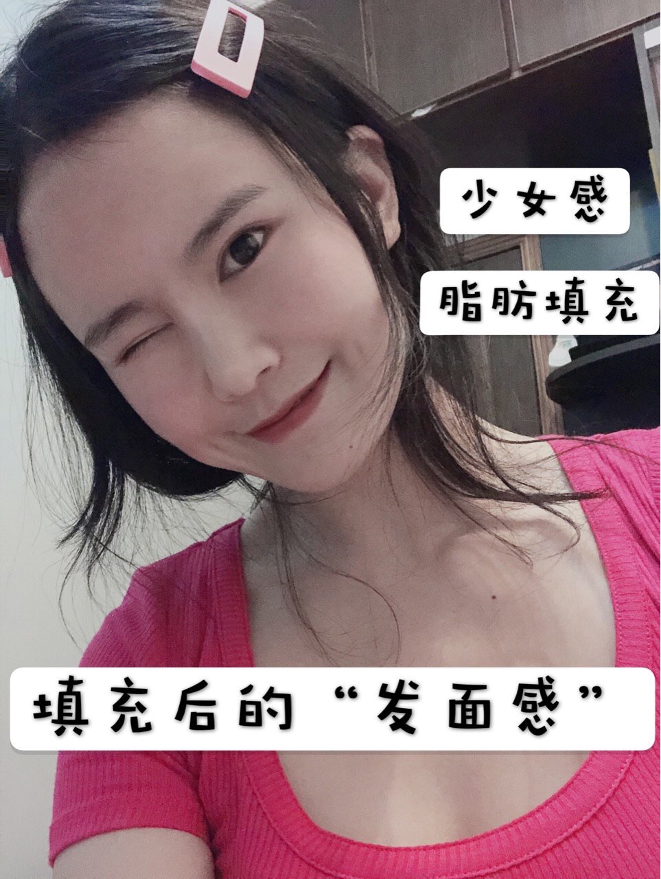 很多姐妹儿都想做脂肪填充,想要充满胶原蛋白的少女感或者说是网红感