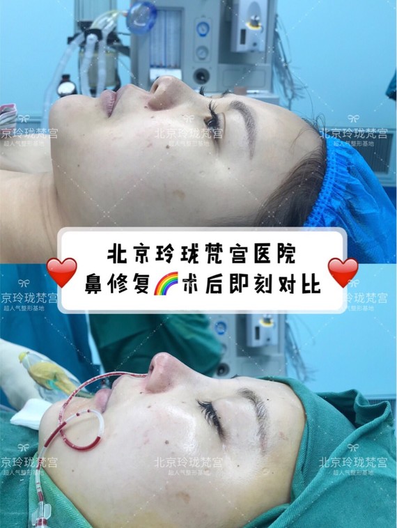什么情况下,有必要取出假体?