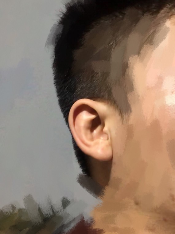 我现在是取软骨的耳朵比原来小了一圈,两耳一大一小!