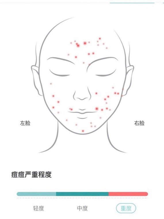 想消灭痘痘得先分清你是哪种痘