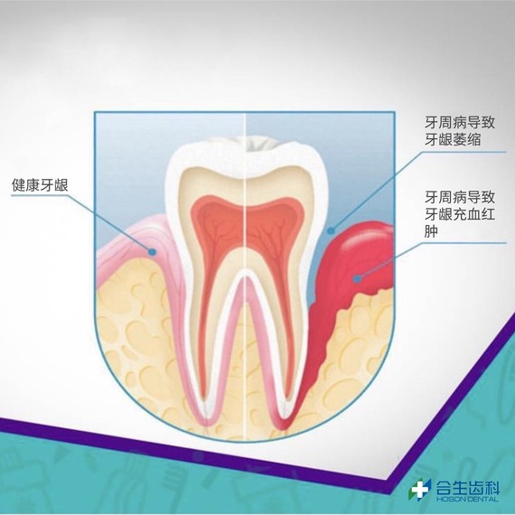 牙龈萎缩是牙周病导致的吗?