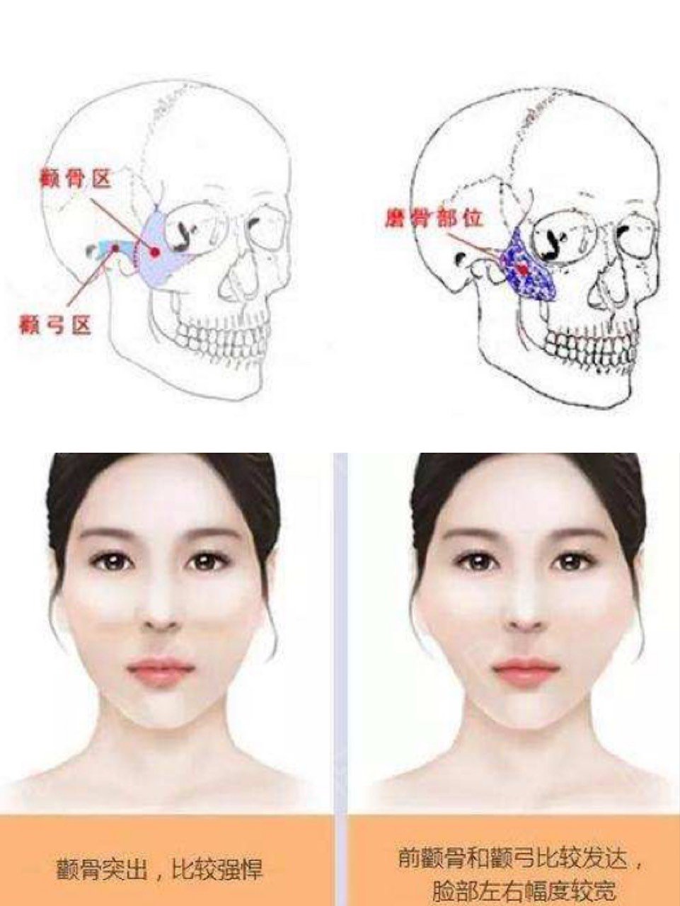 颧骨内推别冲动看看脂肪填充