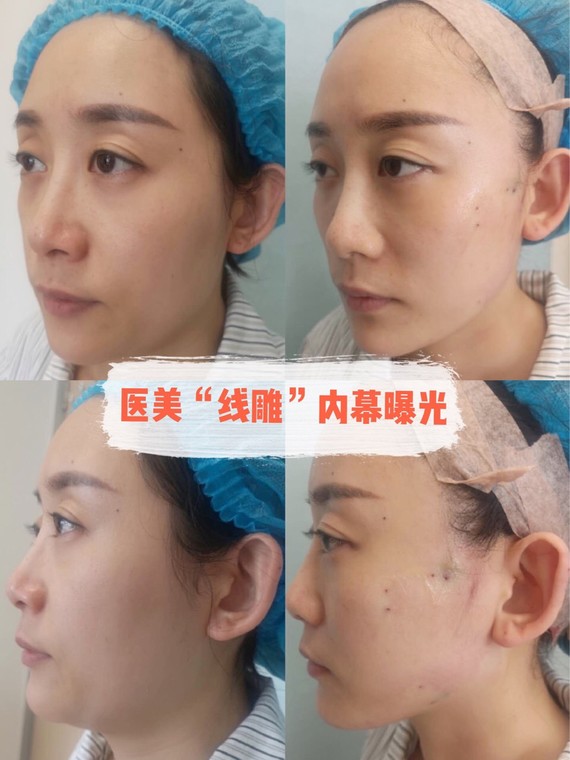面部抗衰