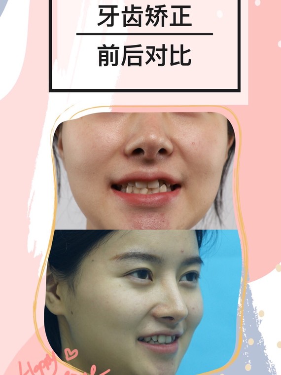 导致孩子牙牙畸形的3个习惯,你家宝宝有几种?