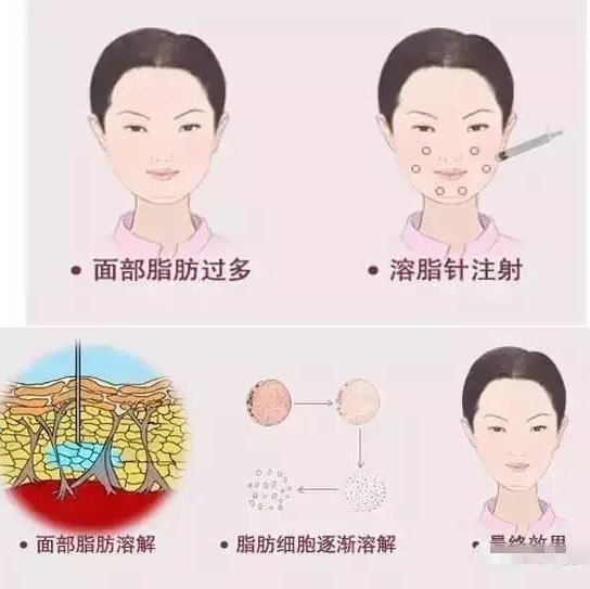 注射溶脂针的注意事项