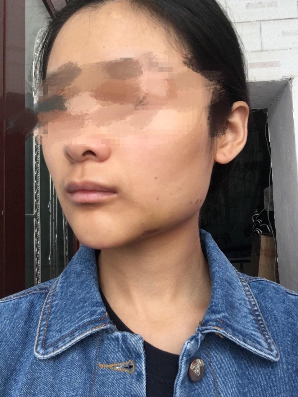 为什么整形失败后不能立即做修复手术?