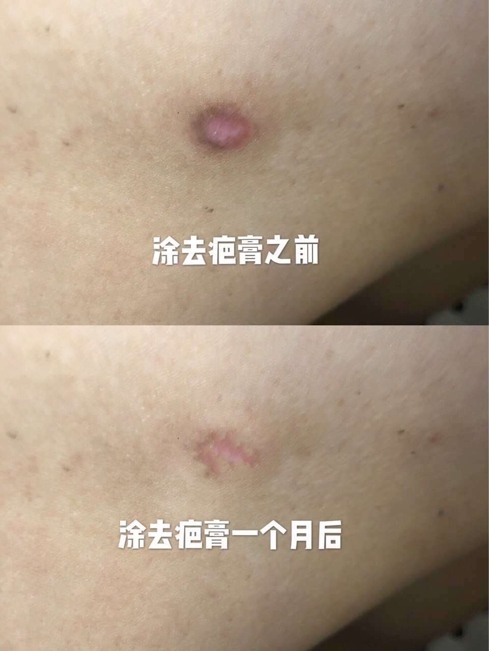 隆胸术后疤痕护理有多重要?