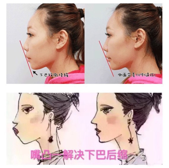 太塌会影响脸型的立体感,下巴短也会看起来显脸大,同样的脸型,短下巴