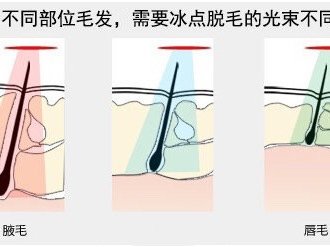 冰点激光脱毛的特点是激光波长能穿透至真皮的深层以及皮下脂肪组织