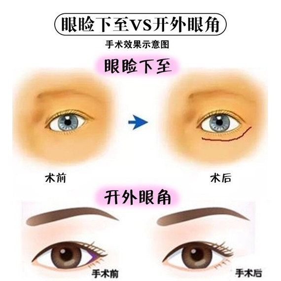 眼睑下至术是什么与开外眼角有什么区别