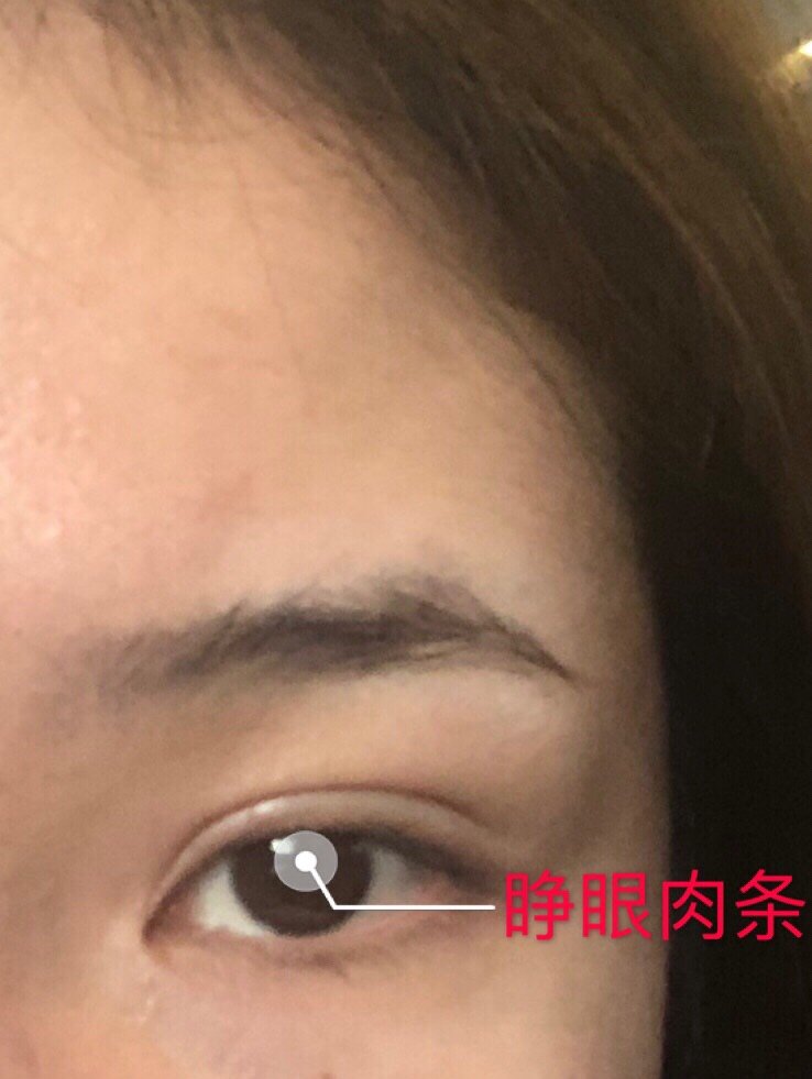 提高【美商"肿泡眼"最容易造成肉条