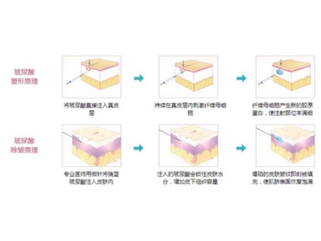 玻尿酸代谢后皮肤会怎样看完就知道了