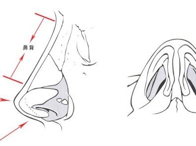 假体隆鼻手术的切口一般选择在鼻小柱或鼻孔内,待把材料植入后,再